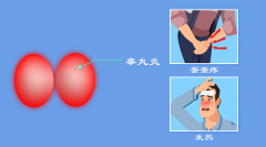 睾丸炎患者应该注意哪些